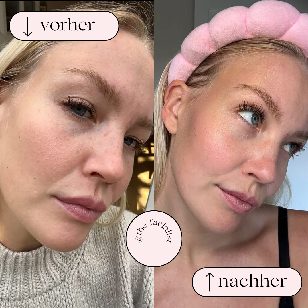 Hydrodermabrasion Porenreiniger – Wasserstoff- und Sauerstoffreinigung
