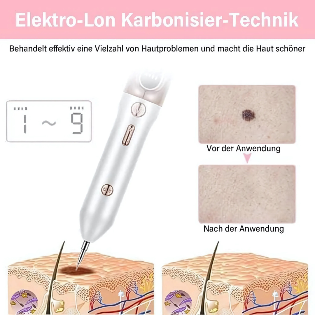 Plasma-Stift zur sicheren Entfernung von Hautmakeln